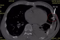 Không thấy vết thương nhưng xương sườn gãy đâm thủng phổi