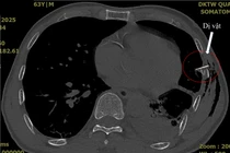 Không thấy vết thương nhưng xương sườn gãy đâm thủng phổi