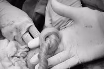 Em bé bị dây rốn thắt nút... chào đời an toàn, cách gì phát hiện sớm?
