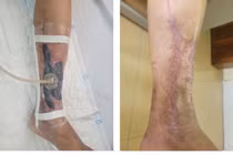 Điều trị hút áp lực âm tránh cắt cụt chi cho người đái tháo đường