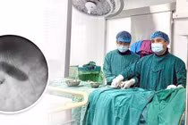 Can thiệp qua da điều trị hẹp eo động mạch chủ cho bệnh nhi 3 tuổi