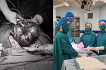 Uống thực phẩm chức năng, đa u xơ tử cung phát triển như thai 6 tháng