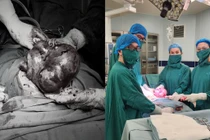 Uống thực phẩm chức năng, đa u xơ tử cung phát triển như thai 6 tháng