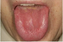 Hội chứng miệng bỏng rát: Bệnh của nhiều chuyên khoa khó chẩn đoán