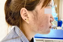 Tự uống thuốc ho và dạ dày người bệnh 30 tuổi bị sốc phản vệ