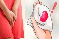 Ra máu sau 7 năm mãn kinh, người phụ nữ 55 tuổi phát hiện ung thư niêm mạc tử cung - Ảnh minh họa 