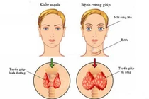 Bệnh Basedow điều trị iốt phóng xạ có gây ung thư?