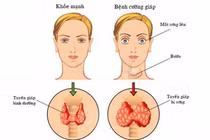 Bác sĩ giải mã bệnh cường giáp phổ biến gây biến chứng tim mạch, lồi mắt