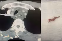 Nhiều ca bệnh bị dị vật đường ăn: Đừng chủ quan biến chứng nguy hiểm