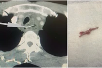 Nhiều ca bệnh bị dị vật đường ăn: Đừng chủ quan biến chứng nguy hiểm