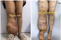 Ghép hạch bạch huyết điều trị phù bạch mạch gây chân tay to