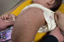 Hà Nội ghi nhận ca đầu tiên tử vong do sởi ở bé gái 4 tuổi