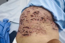 Nhiều người biến chứng nguy kịch do chủ quan với zona thần kinh