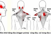 Hội chứng đau cơ xơ hóa là gì?