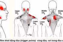Hội chứng đau cơ xơ hóa là gì?
