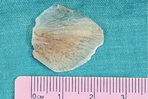 Suýt thủng thực quản vì hóc xương cá ba sa, cách xử trí tránh nguy hiểm