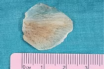 Suýt thủng thực quản vì hóc xương cá ba sa, cách xử trí tránh nguy hiểm