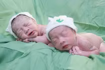 Hành trình kì diệu ca song thai chung bánh rau buồng ối, dây rốn thắt nút