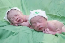 Hành trình kì diệu ca song thai chung bánh rau buồng ối, dây rốn thắt nút