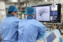 Hết liệt nửa người do đột quỵ nhờ can thiệp mạch máu não kịp thời