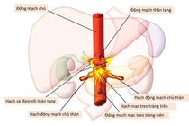 Kỹ thuật giảm đau bụng bằng diệt đám rối thần kinh tạng