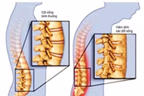 Đau lưng cẩn thận viêm cột sống dính khớp dễ gây tàn phế