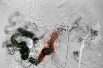 12h "cân não" cắt 3m ruột non cứu người đàn ông mắc bệnh hiếm