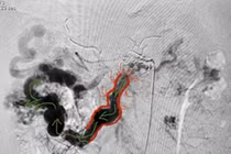 12h "cân não" cắt 3m ruột non cứu người đàn ông mắc bệnh hiếm