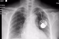 Đặt máy tạo nhịp cứu bệnh nhân tắc nghẽn đường dẫn truyền trong tim