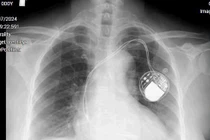 Đặt máy tạo nhịp cứu bệnh nhân tắc nghẽn đường dẫn truyền trong tim