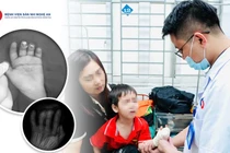 Nghịch dao, trẻ bị đứt lìa nhiều đốt ngón tay