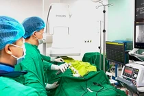 Triệt đốt ổ loạn nhịp tim bằng sóng RF