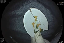 Cụ ông nuốt cả mảnh thìa nhựa 3 cm trong vùng mũi – hầu họng