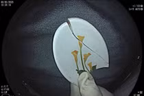 Cụ ông nuốt cả mảnh thìa nhựa 3 cm trong vùng mũi – hầu họng