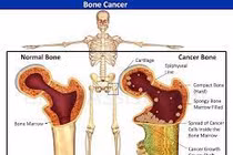 Dấu hiệu cảnh báo xương có vấn đề, cẩn thận ung thư