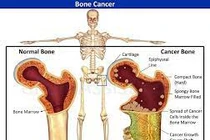 Dấu hiệu cảnh báo xương có vấn đề, cẩn thận ung thư