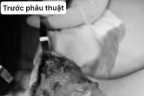 Trẻ 4 tuổi lóc da phức tạp do kẹt chân vào nan hoa xe máy