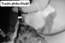 Trẻ 4 tuổi lóc da phức tạp do kẹt chân vào nan hoa xe máy