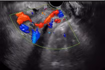 Cuộc chạy đua cấp cứu giành lại sự sống cho sản phụ mạch máu tiền đạo