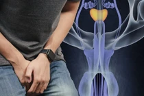 Không đau nhưng cắt bỏ cả 2 tinh hoàn vì ung thư