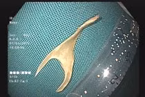 Nhiều người bị dị vật xương lớn mắc tại thực quản, cách tránh trong dịp Tết