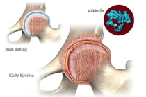 Con đường lây nhiễm viêm khớp gối sinh mủ không do lậu cầu