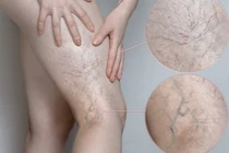 1/3 người trưởng thành bị suy giãn tĩnh mạch: Cách nhận biết để chữa trị