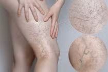 1/3 người trưởng thành bị suy giãn tĩnh mạch: Cách nhận biết để chữa trị