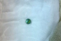 Nội soi gắp viên bi trong dạ dày bé trai 5 tuổi