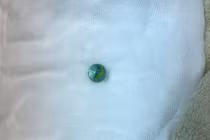 Nội soi gắp viên bi trong dạ dày bé trai 5 tuổi