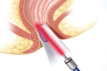 Phẫu thuật trĩ bằng laser: Giải pháp hiệu quả và an toàn?