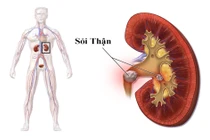 Địa chỉ vàng: Các bệnh viện điều trị sỏi thận tốt tại Hà Nội