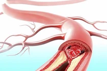 Công thức "vàng" làm sạch mạch máu hiệu quả