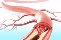 Công thức "vàng" làm sạch mạch máu hiệu quả